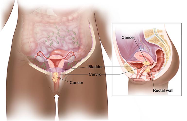 Cervical Cancer