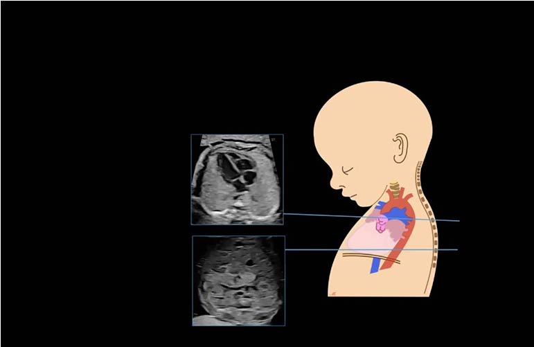 Fetal Echocardiography