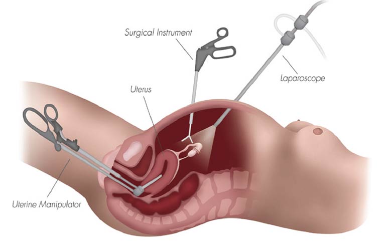 Hysterectomy (Abdominal, Vaginal, Laparoscopic)