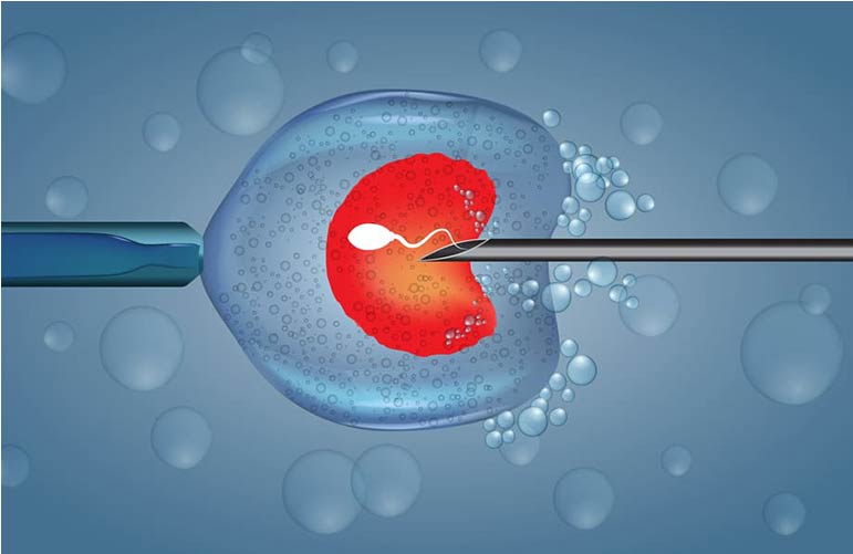 Intracytoplasmic Sperm Injection (ICSI)