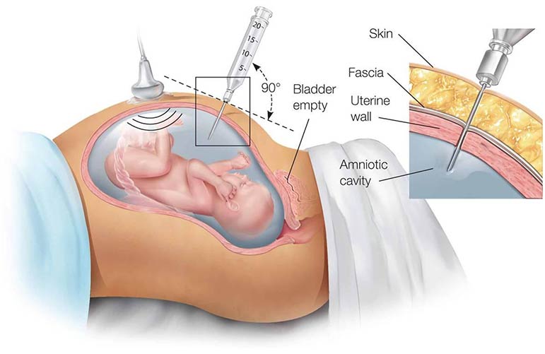 Prenatal Diagnosis