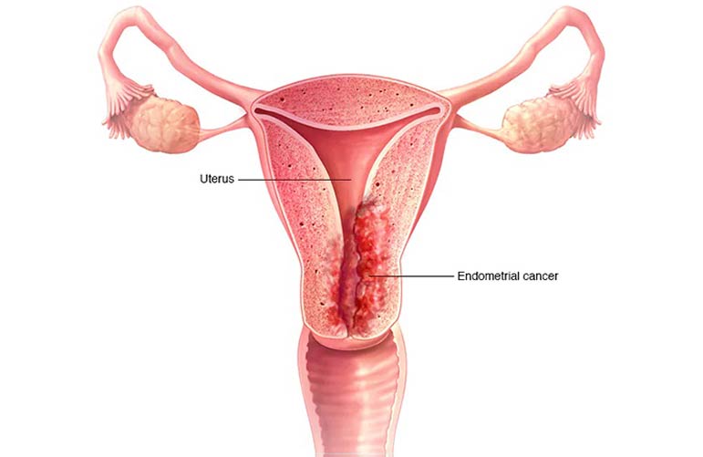 Uterine Cancer